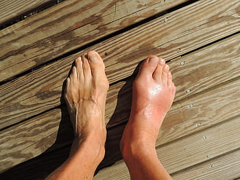 il piede della persona, piedi, gotta, dolore, piede, umano, anomalia, a piedi nudi, piede piatto, dita dei piedi, caviglia