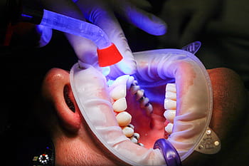 person, dental, session, dentist, facet, uv light, curing, teeth, mouth, treatment, uv lamp