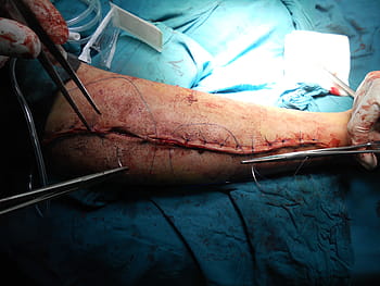 osoba, operaci paže, chirurgická operace, ortopedické, paže, nemocnice, doktor, zdravotní péče, medicína, tělo, anatomie