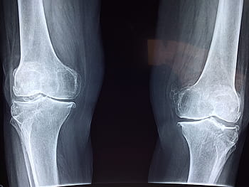 fotografie, člověk, výsledky nohou kolena x-ray, koleno, rentgen, lékařský, anatomie, kostra, kost, ortopedické, kloub